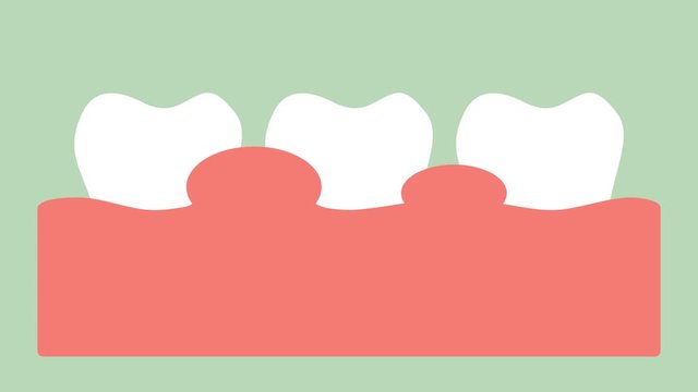 gingivitis or gum disease, gum inflammation before periodontal disease - dental cartoon 2d animation in 4K