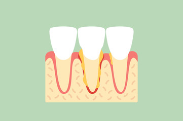 periodontal disease or gingivitis of incisor tooth