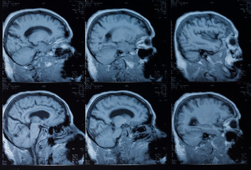 Head MRT. MR image of human brain