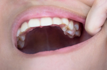 Crowding teeth. malocclusion teeth. In the mouth of this child with permanent teeth up insert the milk teeth that have not dropped.