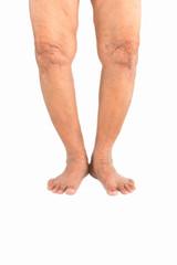 Elderly woman Varus deformity or bow legs - obrazy, fototapety, plakaty