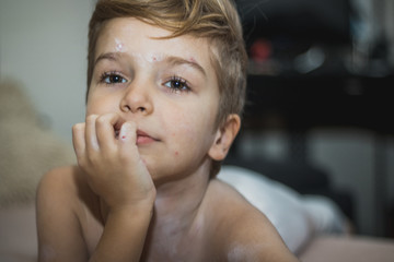 Little boy with chickenpox.