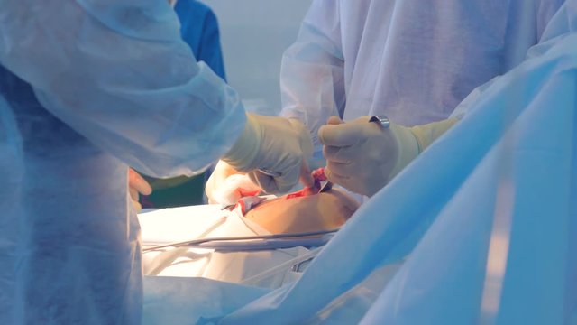 A surgeon removes soft organ tissue from patients abdomen. 