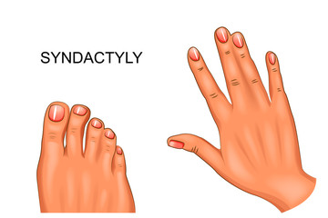 syndactyly. webbed hand and foot