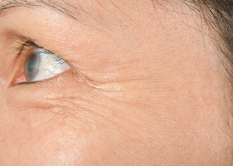 Wrinkles on the eyes