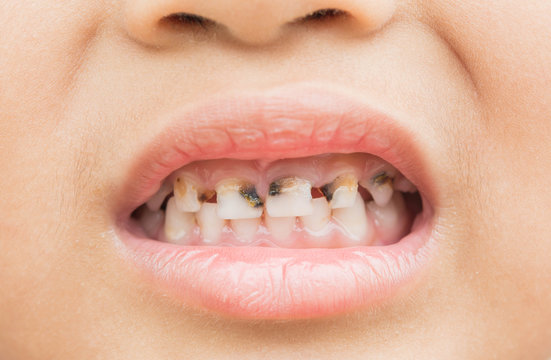 Broken teeth in children