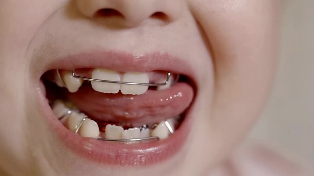 Close up shot of little girl's teeth with brackets.