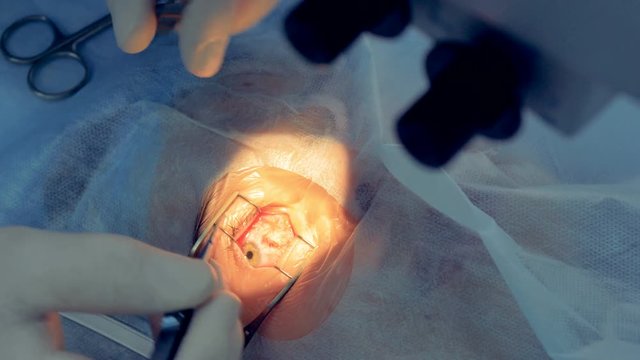 A close-up view on an eye ball getting stitched. 