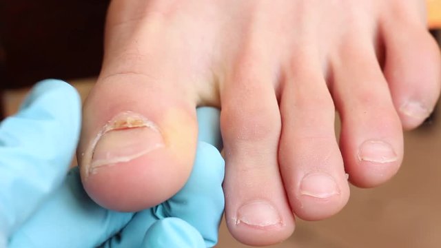 Horizontally split nail. Surgical removal of the dorsal nail will correct the problem