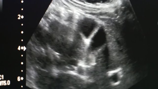 A stunning X-ray view of a a pregnant woman stomack with a small baby in it. The baby moves actively and his head and legs are seen. 