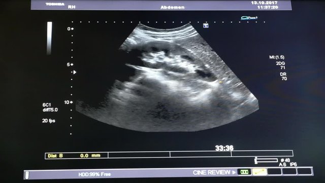A striking X-ray view of a a pregnant woman belly with a small baby in it. The baby moves actively and his head and legs are seen. 