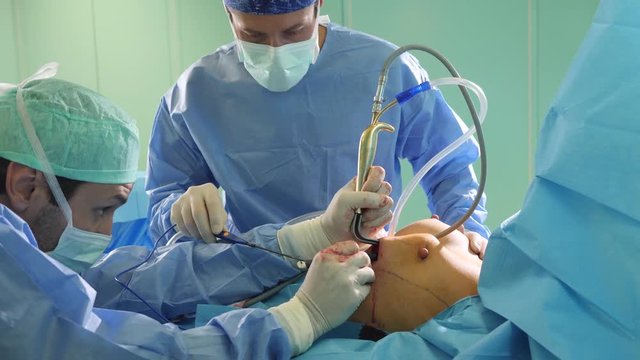 Real surgery team in the operating room. Live session of breast augmentation surgery. 4K slow motion video.