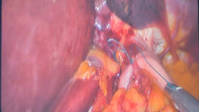 A camera shows how surgeons stitch internal organs.  
