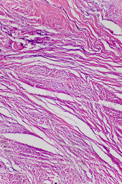 Connective tissue hyaline degeneration of human