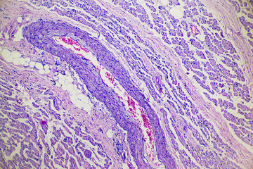 Muscular atrophy of human skeletal muscle