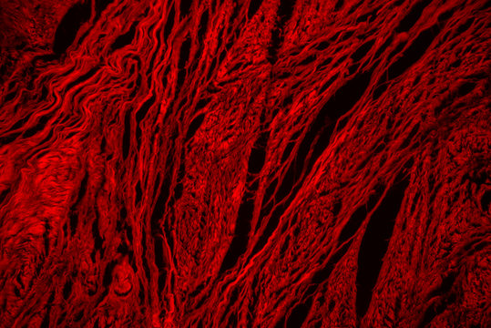 Connective tissue hyaline degeneration of human