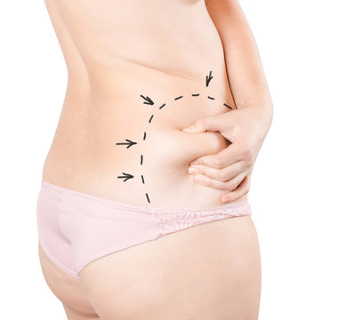 Plastic Surgery Of The Female Body. Liposuction Of The Tummy Tuck, Waist. Drawing Arrows And Lines With Perforation For Preparation For Surgery. Fat Woman In Underwear Isolated On White Background