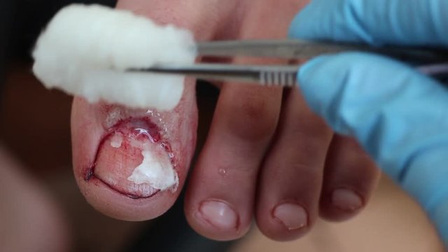 Surgical procedures for nail disorders. Nail surgery treatment and management