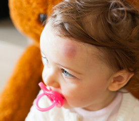 Toddler with big bruise on his forehead after bumping.