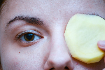 Redhead model using slices of potato to relieve her dark circles and puffy eyes