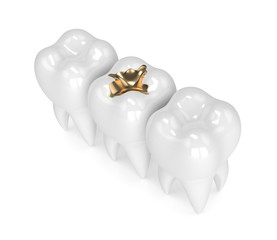 3d render of teeth with dental gold filling