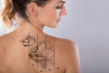 Laser Tattoo Removal On Woman's Shoulder - obrazy, fototapety, plakaty