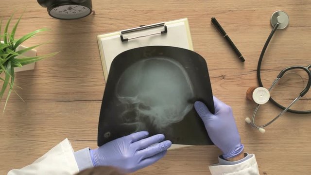 Overhead view of doctor examining x-ray of the patient's skull in a medical clinic. Healthcare professional analyzing imaging test of human head.