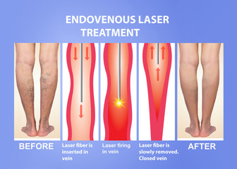 Varicose Veins and laser