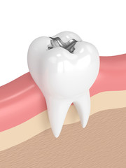 3d render of tooth with dental amalgam filling