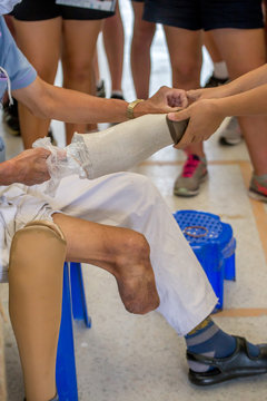 The Amputee Is Being Checked During Making New Plastic Prosthesis.
