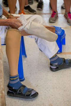 The Amputee Is Being Checked During Making New Plastic Prosthesis.