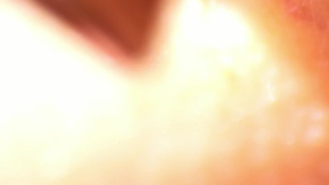 Tick Removal from Human Skin