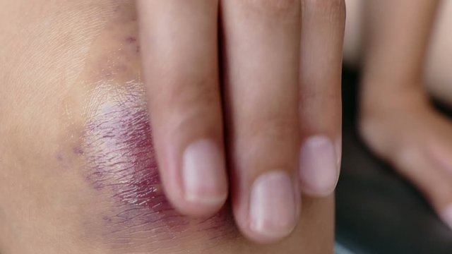 4K, A girl rubs her fingers with a curative ointment in a bruised knee 