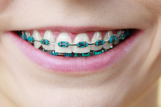Closeup of woman teeth with braces