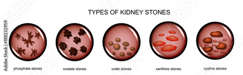 types-of-kidney-stones-stock-image-and-royalty-free-vector-files-on