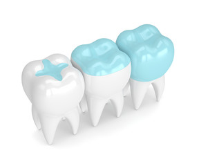 3d render of teeth with different types of filling