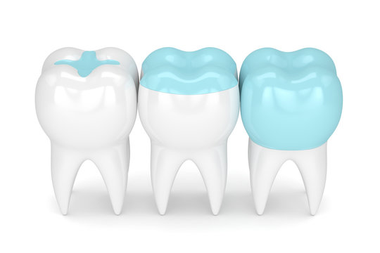 3d Render Of Teeth With Different Types Of Filling