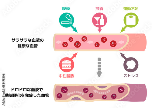 サラサラ血液の健康な血管が不健康要因により ドロドロ血液になり動脈硬化を引き起こすイラスト Wall Mural Barks