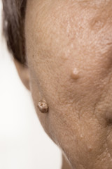 Fototapeta premium Elderly pensioner female, dermal fibroma closeup.