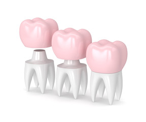 3d render of  replacement crown cemented onto reshaped tooth