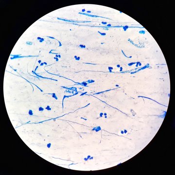 Smear of Acid-Fast bacilli (AFB) stained from sputum specimen, under 100X light microscope, selective focus.
