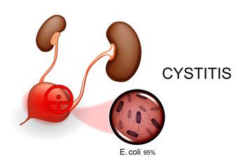 bladder and kidneys. cystitis