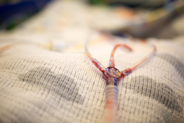 Chest drain following operation