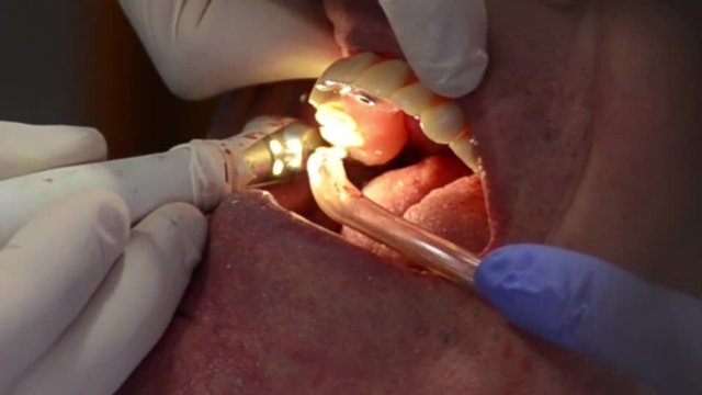 dentista effettua operazione di implantologia su di un paziente