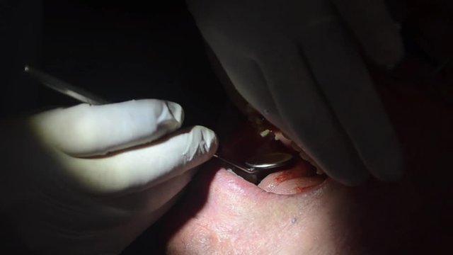 dentista effettua operazione di implantologia su di un paziente