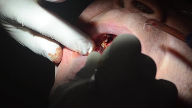 dentista effettua operazione di implantologia su di un paziente