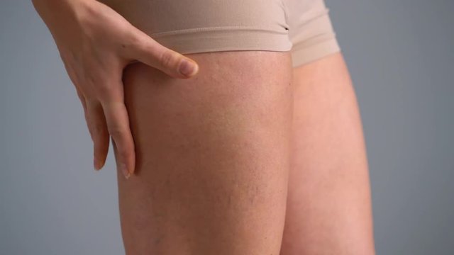 Female hip stretch marks and cellulite on the skin
