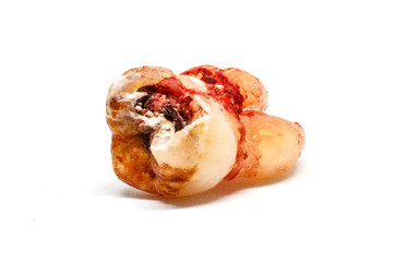 Isolated wisdom tooth decay.