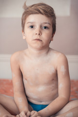 Small boy with chickenpox.