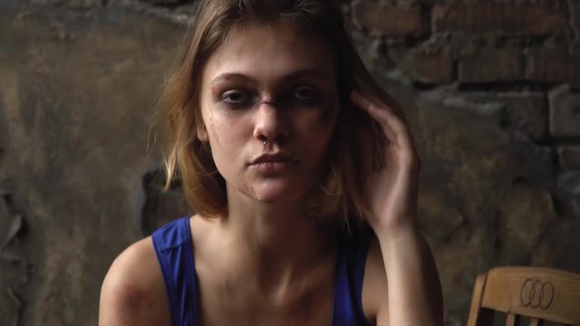 A girl with a bruise under her eye adjusts her hair and looks down